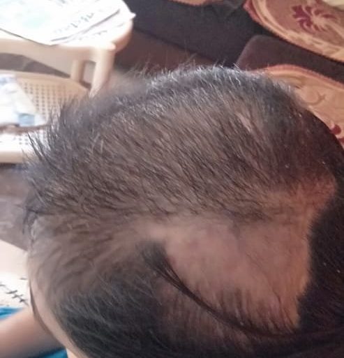 Trichotillomania Since 13 Years getting Cured