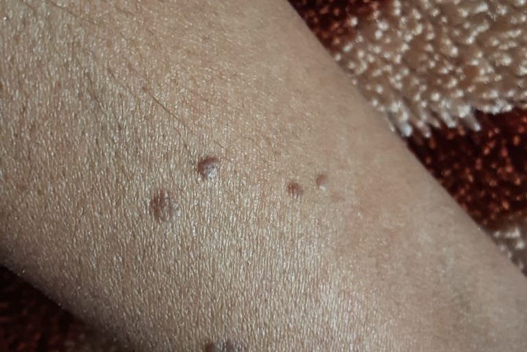 Ugly Warts Cured with Classical Homeopathy