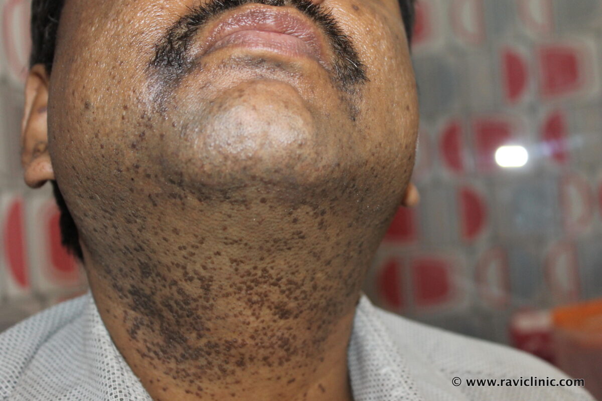 Ugly Warts- Verruca Plana-  for many Years Cured with Classical Homeopathy