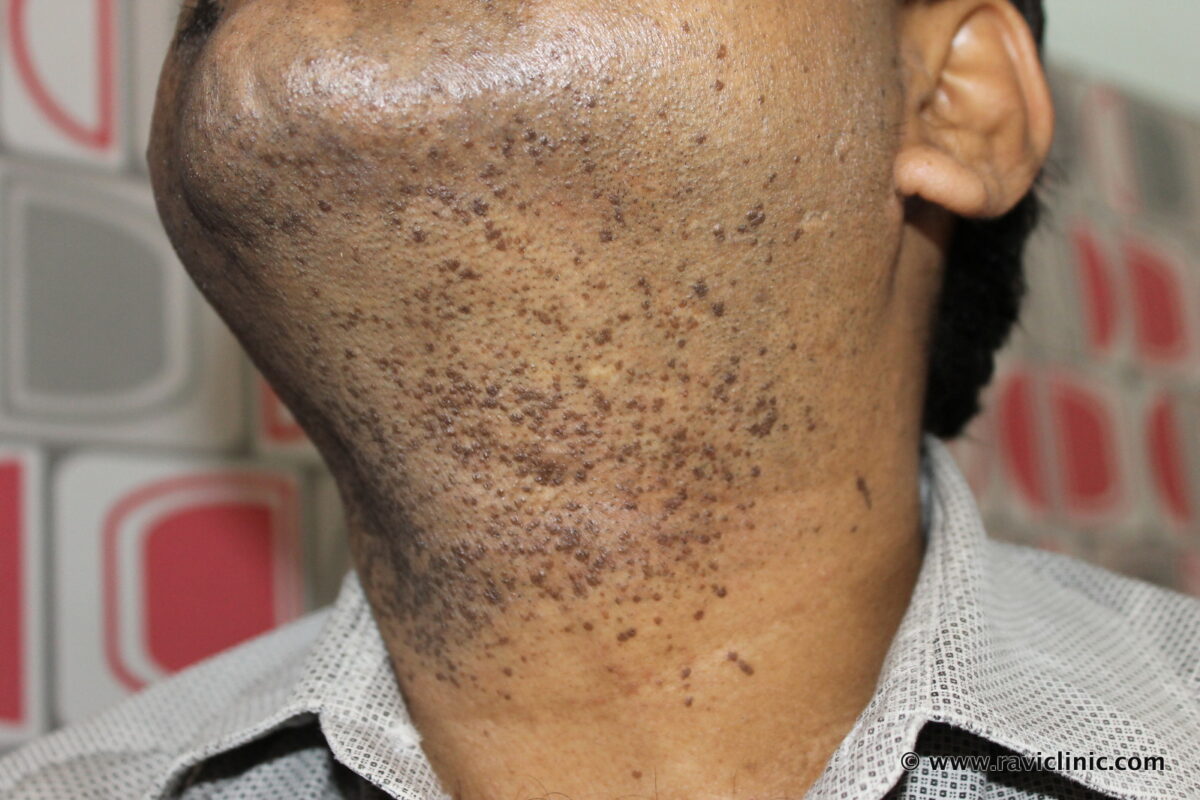 Ugly Warts- Verruca Plana-  for many Years Cured with Classical Homeopathy