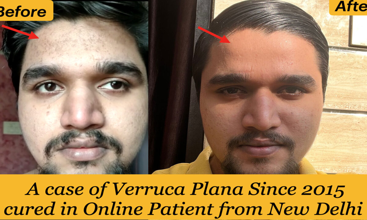 Flat warts Verruca Plana Since 6 years Cured in Online Patient