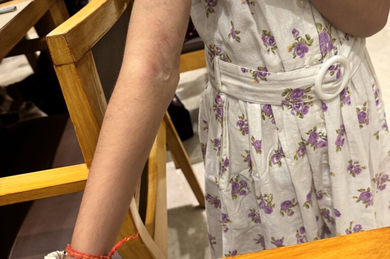 Excellent Recovery in a Case of Hemangioma