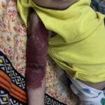 Excellent Recovery in a Case of Hemangioma