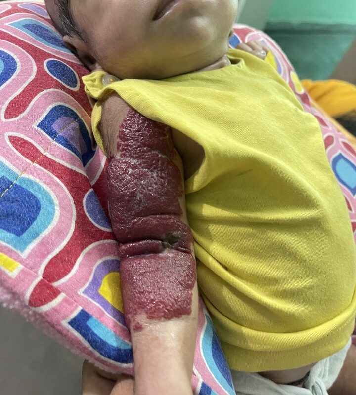 Excellent Recovery in a Case of Hemangioma