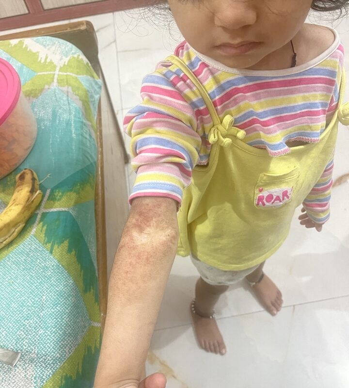 Excellent Recovery in a Case of Hemangioma