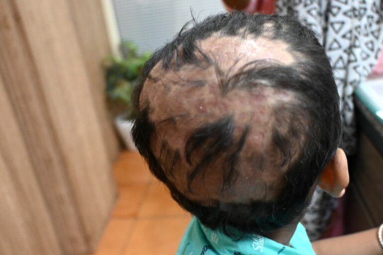 A case of Lichen Planopilaris in a boy got cured
