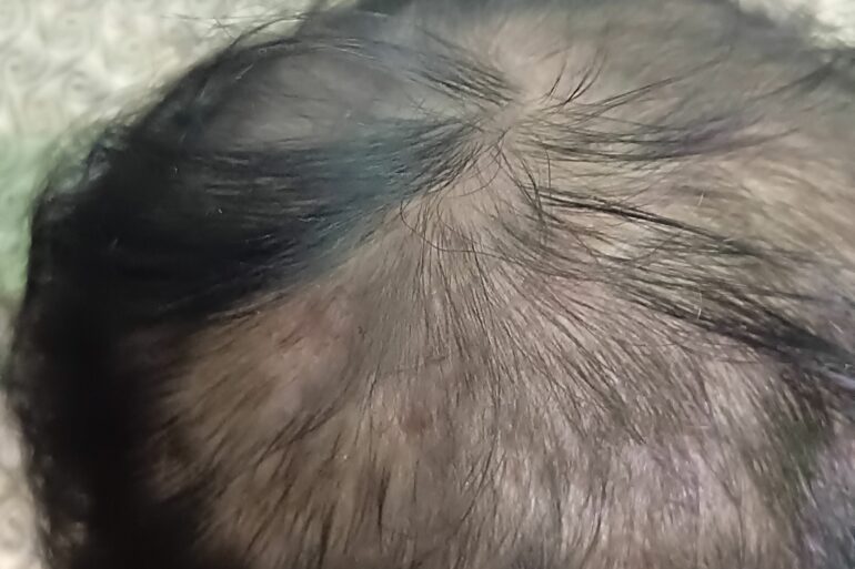 A case of Lichen Planopilaris in a boy got cured