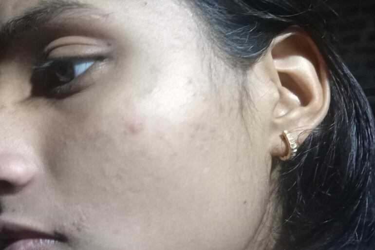 Miraculous Recovery from Flat Warts SINCE 8 YEARS IN A HOPELESS PATIENT