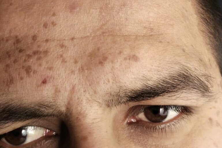 Flat warts for 5 years got cured in Online patient