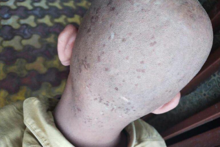Flat warts for 5 years got cured in Online patient