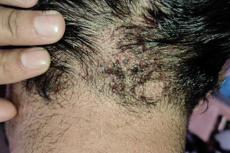 A case of Acne keloidalis nuchae for 7 years  Got cured in Online patient