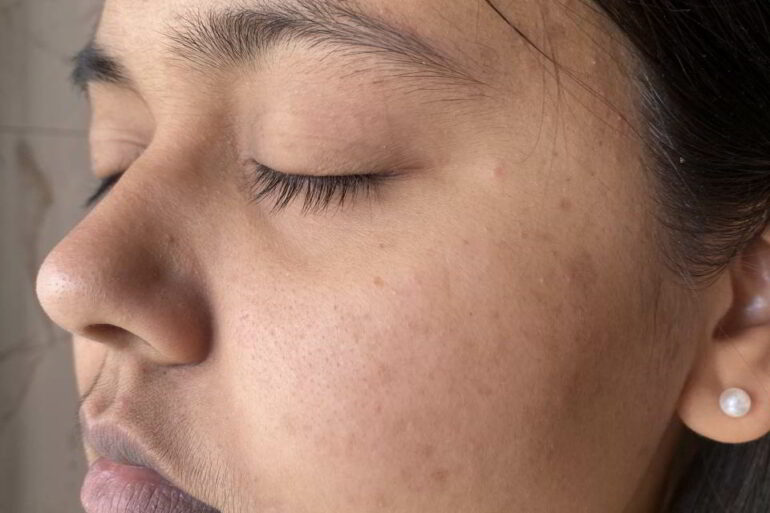 Flat Warts Since 2016 in girl from Shillong Got Cured