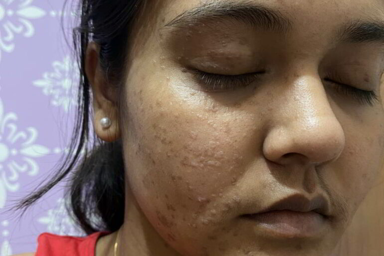 Flat Warts Since 2016 in girl from Shillong Got Cured