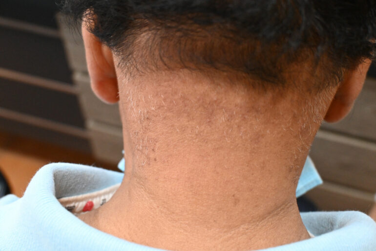 A Case of Acne keloidalis nuchae