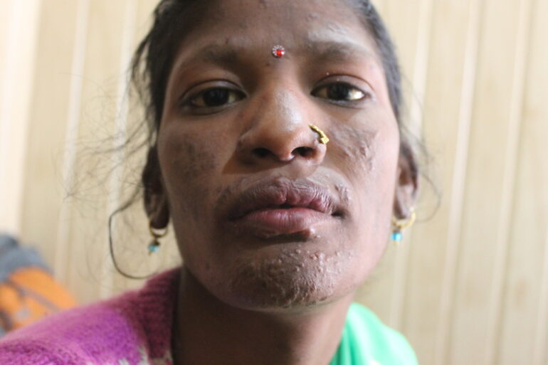 Management of Cutaneous Tuberculosis: A Case Study from a Rural Clinic in Balrampur