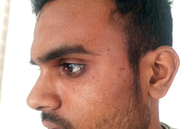 Flat warts for 1 years got cured in 1 week in a patient from Gurgaon