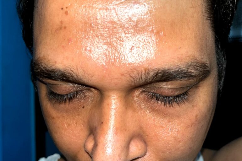Case Study: Rapid Recovery of 9 months long Flat Warts or verruca plana in 3 days