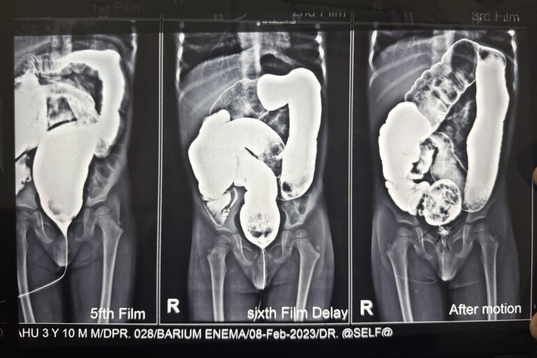 Well Diagnosed case of Hirschsprung’s disease getting cured- Case from Unnao