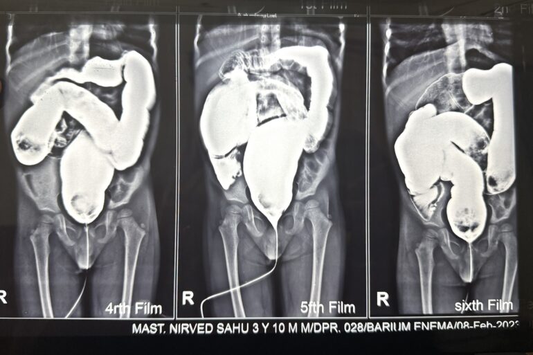 Well Diagnosed case of Hirschsprung’s disease getting cured- Case from Unnao