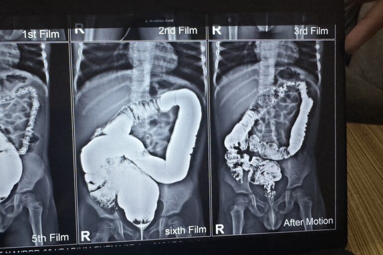 Well Diagnosed case of Hirschsprung’s disease getting cured- Case from Unnao