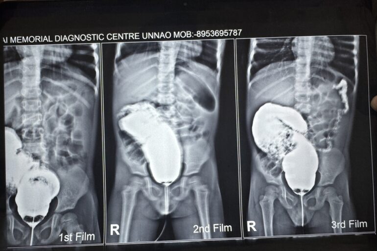 Well Diagnosed case of Hirschsprung’s disease getting cured- Case from Unnao