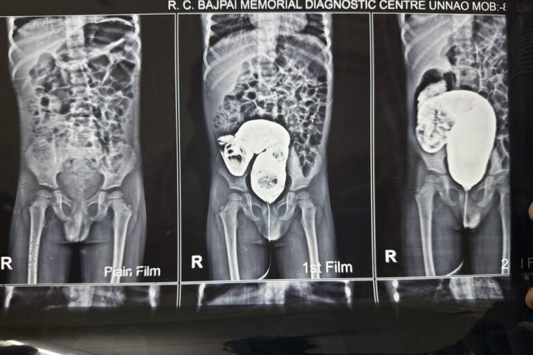 Well Diagnosed case of Hirschsprung’s disease getting cured- Case from Unnao