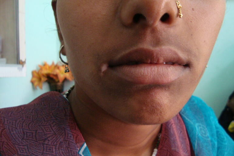 Long term vitiligo at the corner of mouth cured