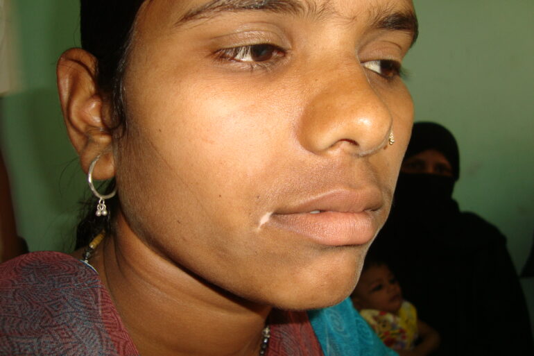 Long term vitiligo at the corner of mouth cured