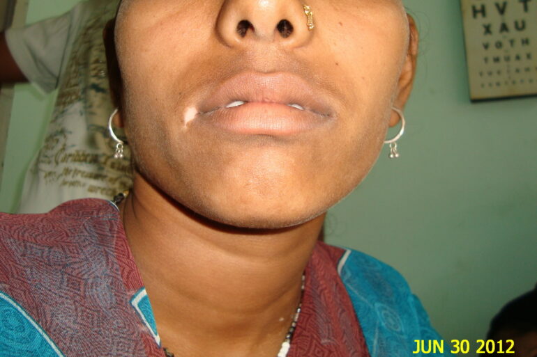 Long term vitiligo at the corner of mouth cured