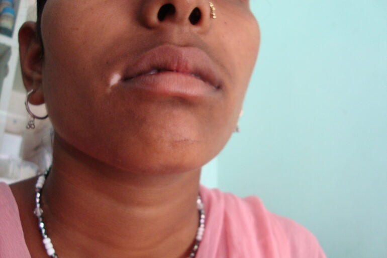 Long term vitiligo at the corner of mouth cured