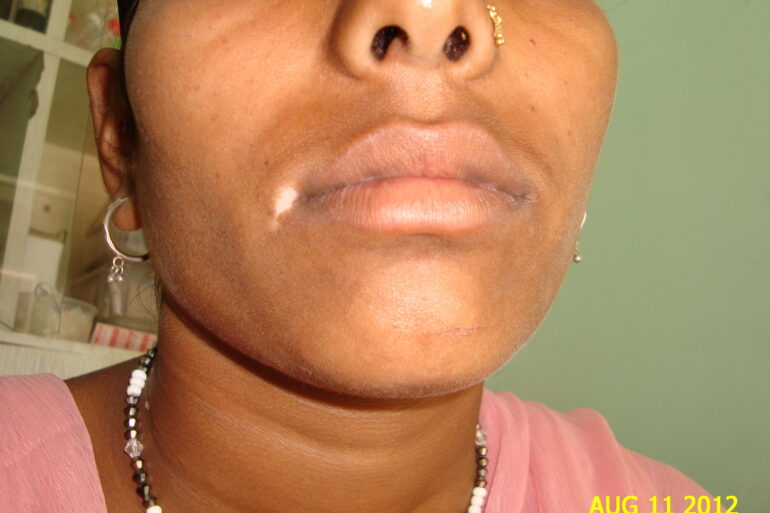 Long term vitiligo at the corner of mouth cured