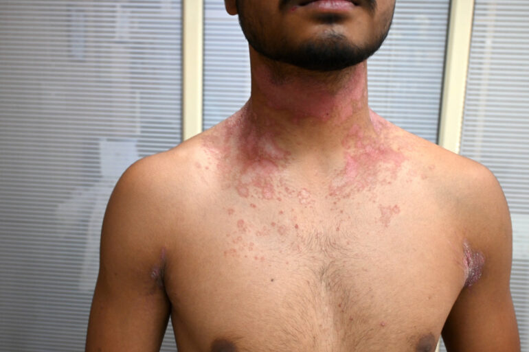 Successful Treatment of Chronic Psoriasis through Classical Homeopathy