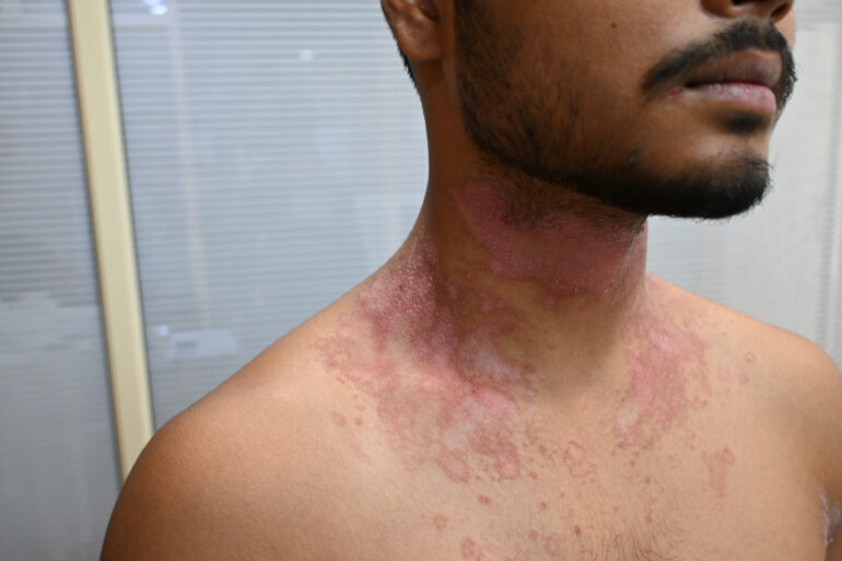 Successful Treatment of Chronic Psoriasis through Classical Homeopathy