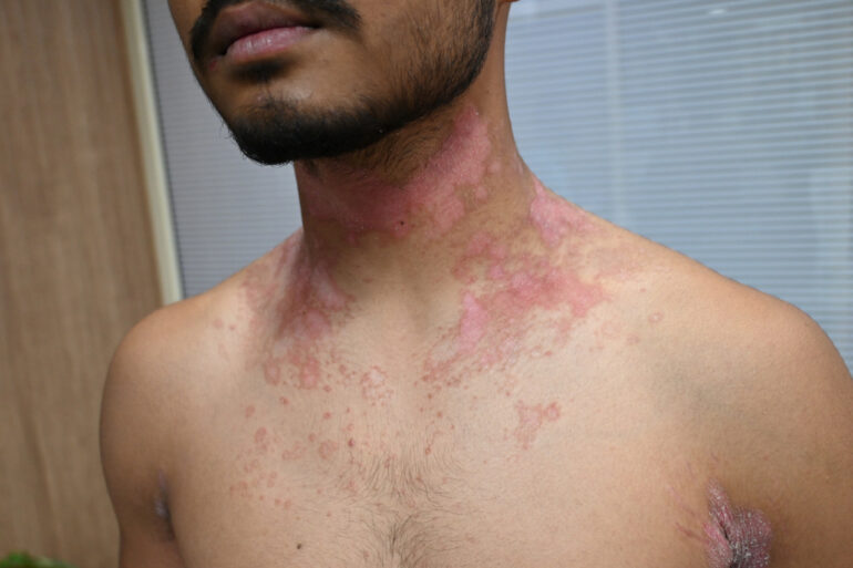 Successful Treatment of Chronic Psoriasis through Classical Homeopathy