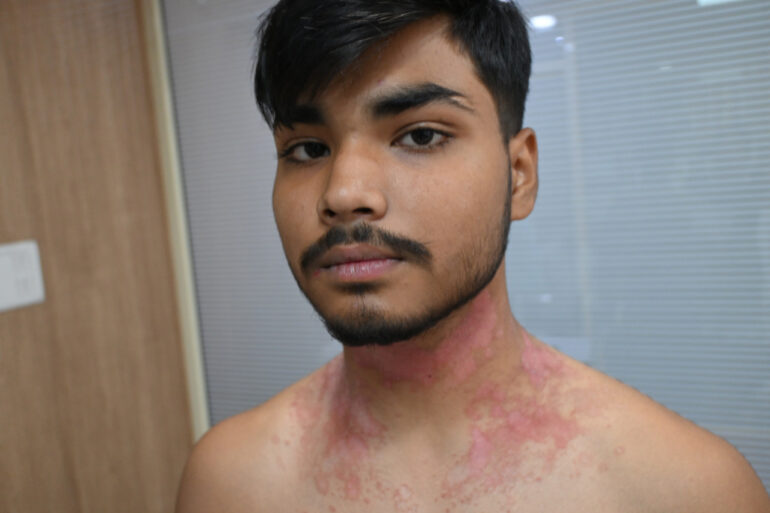 Successful Treatment of Chronic Psoriasis through Classical Homeopathy