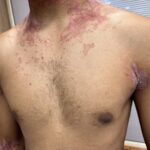 Successful Treatment of Chronic Psoriasis through Classical Homeopathy