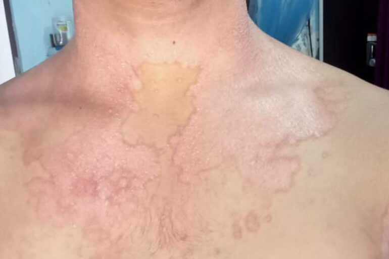 Successful Treatment of Chronic Psoriasis through Classical Homeopathy