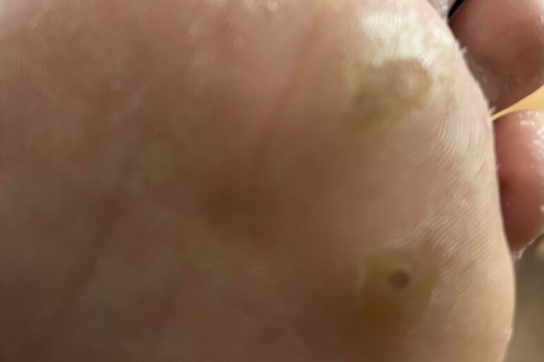 A Case of Corn/Plantar Warts from Canada