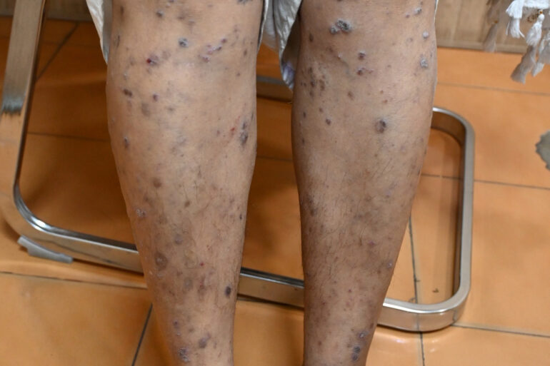 Complete Recovery from Eruptive Lichen Planus with Medicine Transmission Through Hair