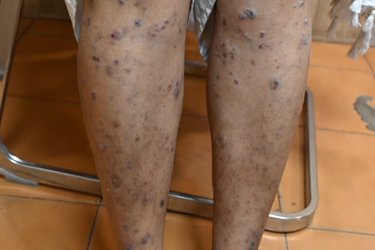 Complete Recovery from Eruptive Lichen Planus with Medicine Transmission Through Hair