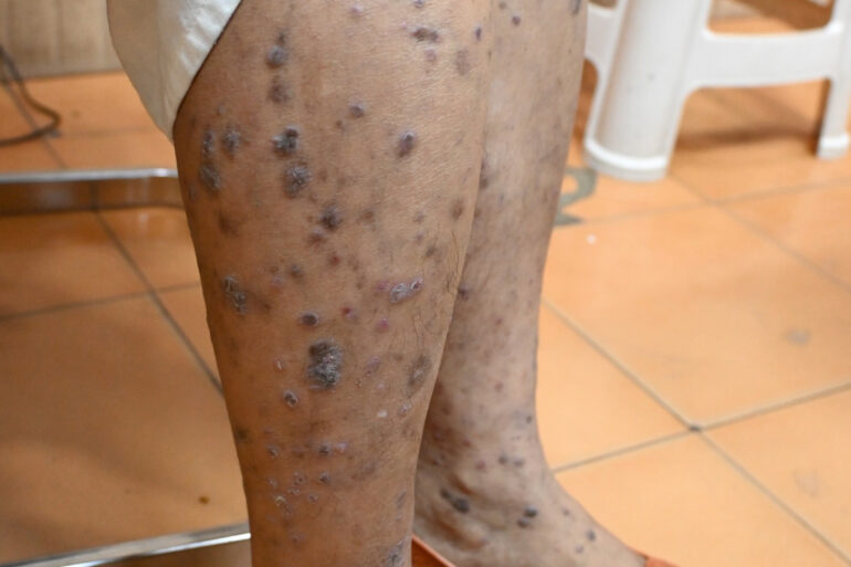 Complete Recovery from Eruptive Lichen Planus with Medicine Transmission Through Hair