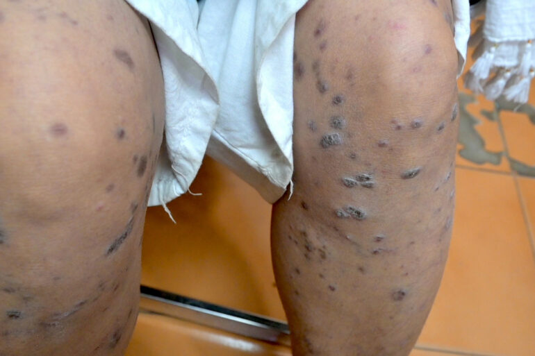 Complete Recovery from Eruptive Lichen Planus with Medicine Transmission Through Hair