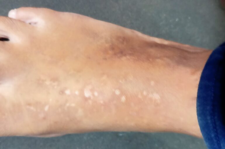 Cure of 15 years long Acrokeratosis verruciformis refused from AIIMS