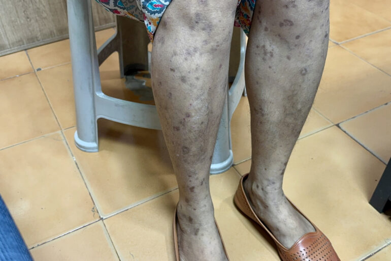 Complete Recovery from Eruptive Lichen Planus with Medicine Transmission Through Hair