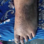 Cure of 15 years long Acrokeratosis verruciformis refused from AIIMS