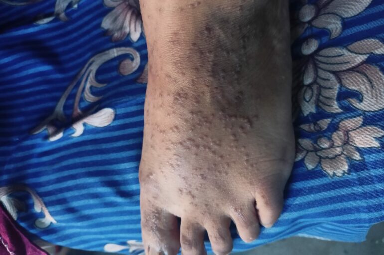 Cure of 15 years long Acrokeratosis verruciformis refused from AIIMS