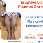 Complete Recovery from Eruptive Lichen Planus with Medicine Transmission Through Hair