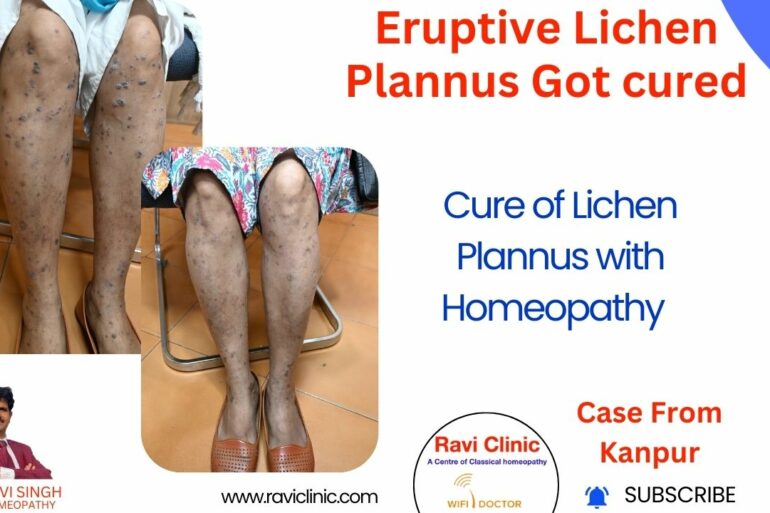 Complete Recovery from Eruptive Lichen Planus with Medicine Transmission Through Hair