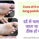 Painful Corns in a Young Boy got cured. No recurrence after many months