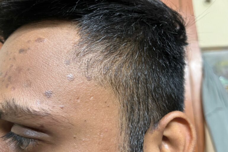 A case of Flat warts for 10 Years Got Cured